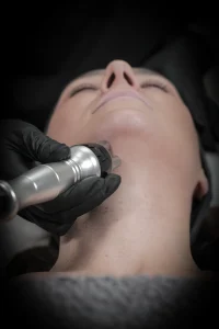 Radio frequency skin tightening treatment at You Glow Aesthetics targeting the jawline and neck