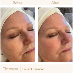 Before and after facial treatment at You Glow Aesthetics showing improved skin texture, reduced fine lines.