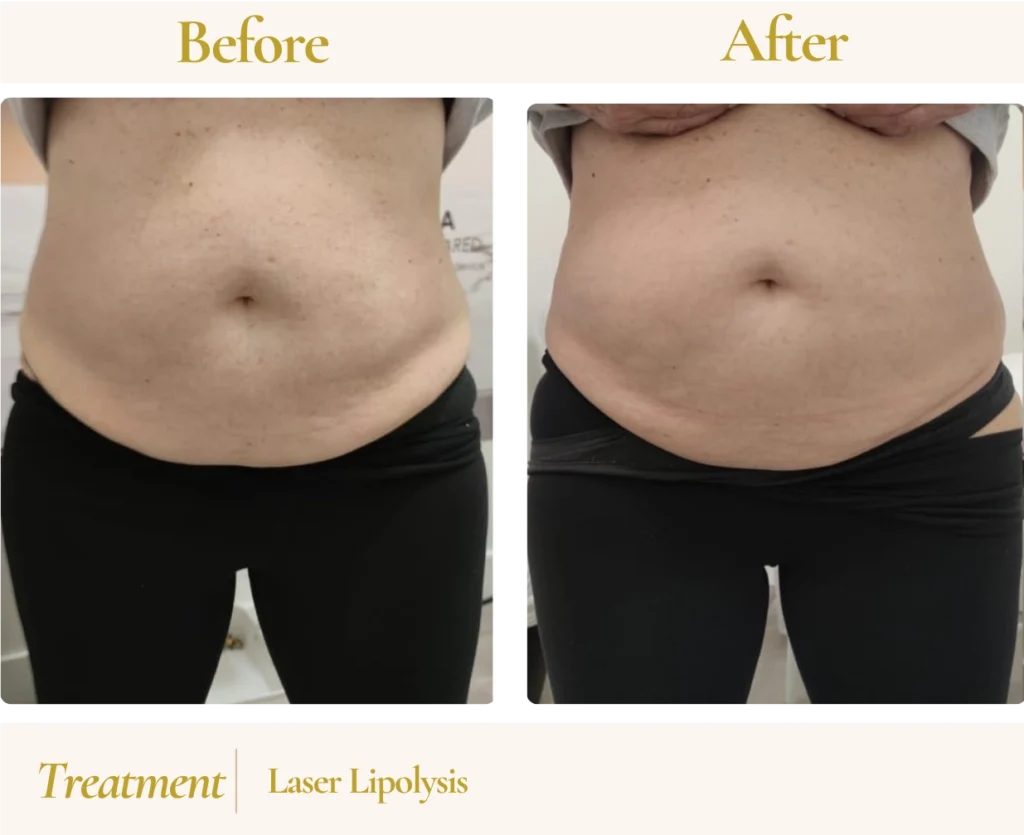 How Laser Lipo Works: From Consultation to CoolSculpt-Style Results