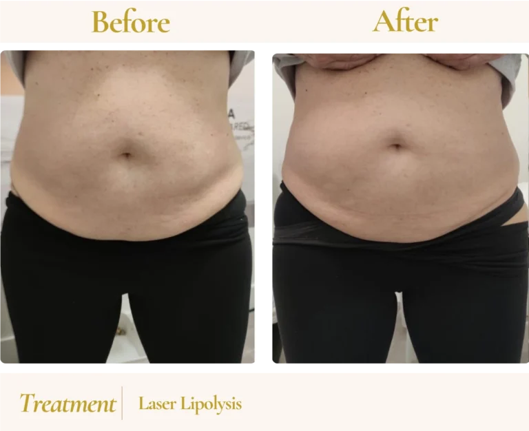 How Laser Lipo Works: From Consultation to CoolSculpt-Style Results