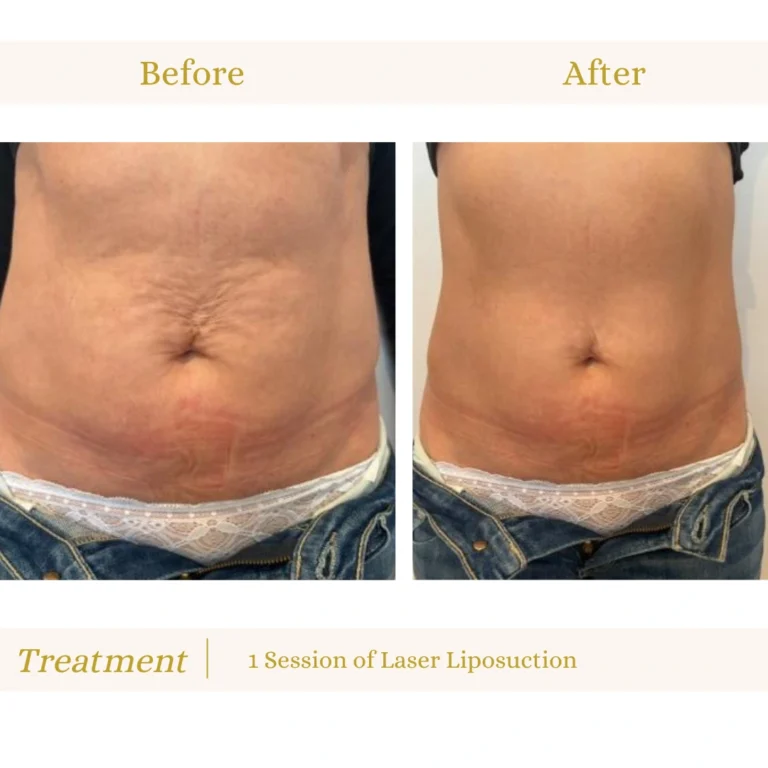The Science of Fat Reduction: Why Laser Lipo Actually Works