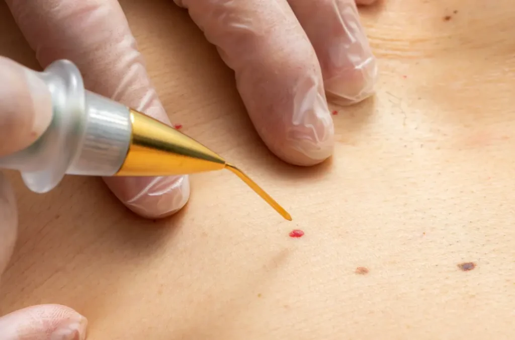 Warts Removal treatment at YOU Glow Aesthetics for smooth, clear skin.