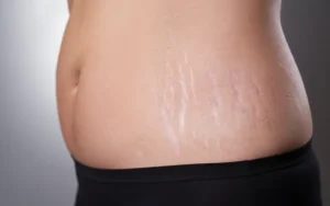 Stretch Marks Concerns