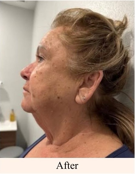Double Chin Removal After