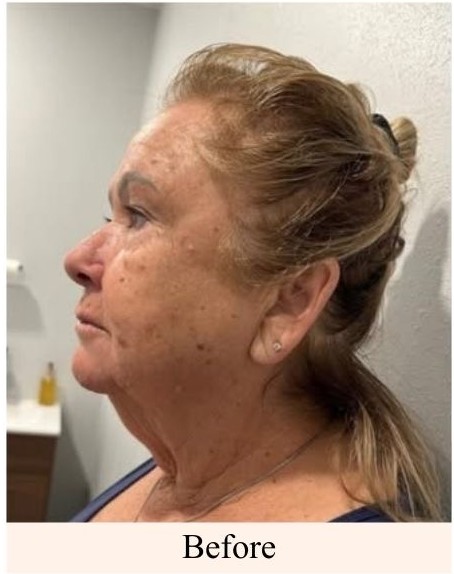 Double Chin Removal Before