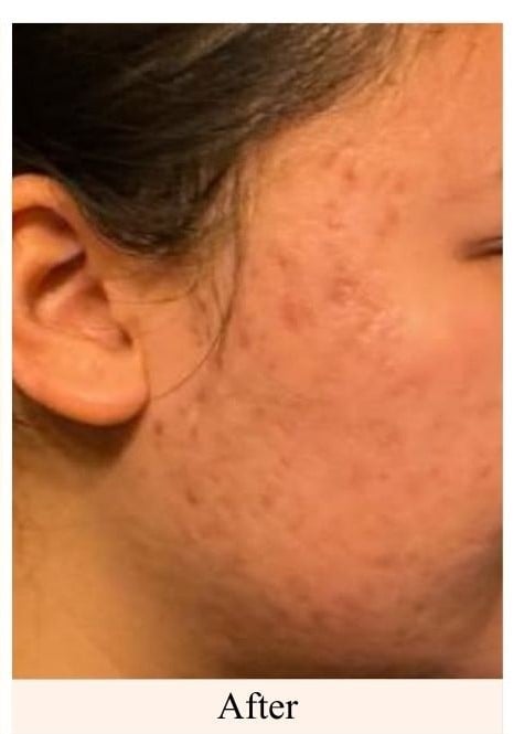 After a course of microneedling for acne scarring at You Glow Aesthetics