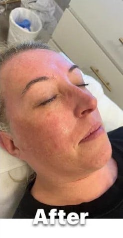 After- Blue-Light-Therapy