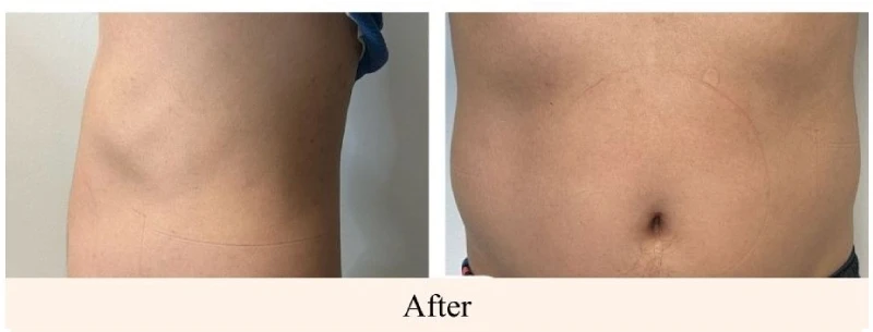 After-EMS-Sculpting-Lower-Stomach