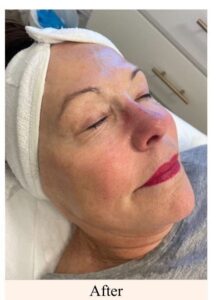 After-Hydro-Facial-Client-4
