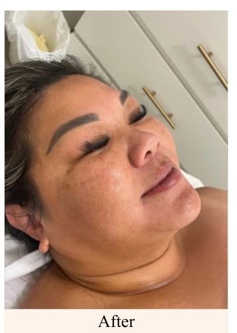 After- LED Light Therapy