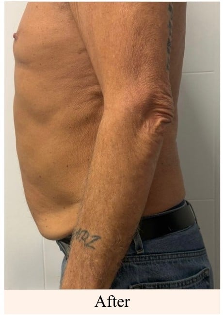 After laser lipo cavitation on the lower stomach at You Glow Aesthetics
