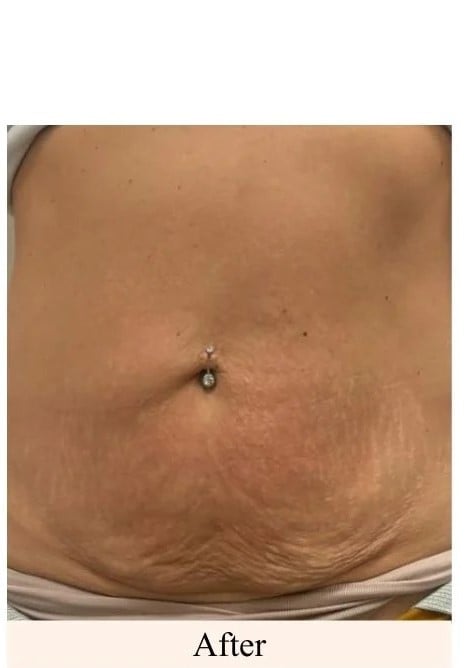 After Laser-Lipolysis-Lower-Stomach