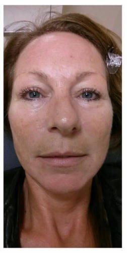 After- Oxygen-facial