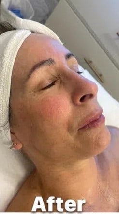 After- carbon-laser-peel