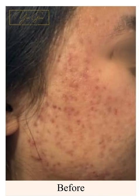 Before a course of microneedling for acne scarring at You Glow Aesthetics