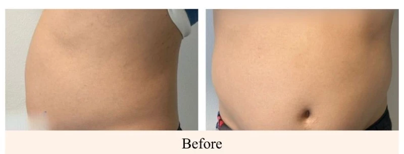 Before-EMS-Sculpting-Lower-Stomach