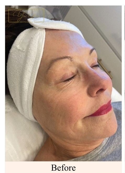 Before-Hydro-Facial-Client-4