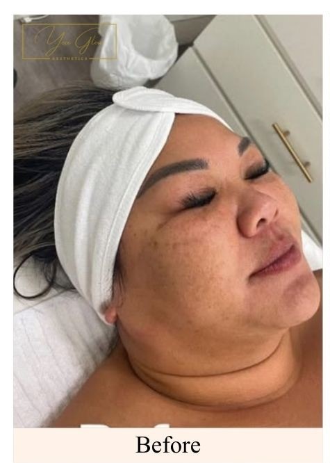 Before - LED Light Therapy