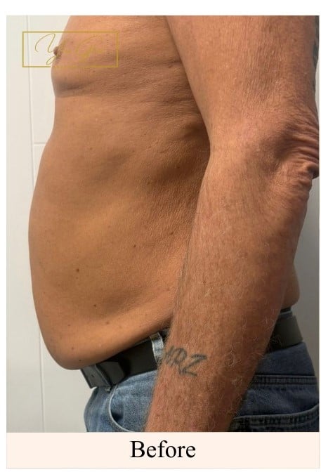 Before laser lipo cavitation on the lower stomach at You Glow Aesthetics