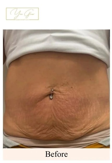 Before- Laser-Lipolysis-Lower-Stomach