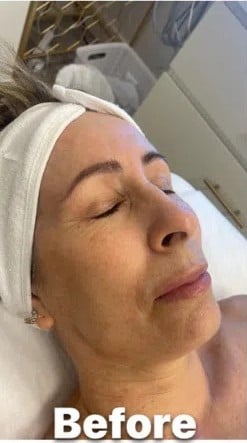 Before- carbon-laser-peel