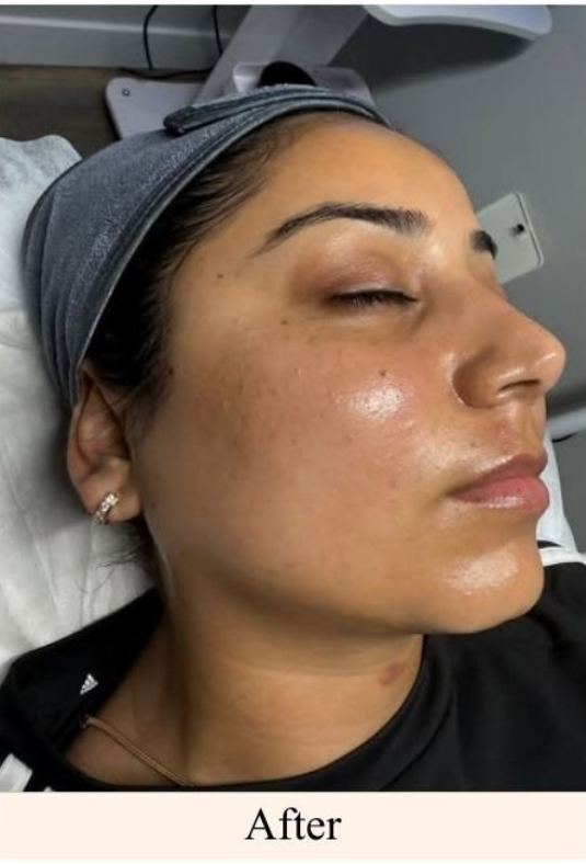 Dermaplaning After
