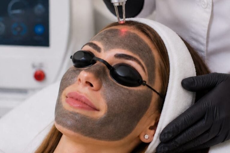 Carbon Peel Facial Treatments in Toronto