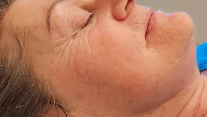 after-face-lift-treatment