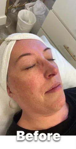 before- Blue-Light-Therapy