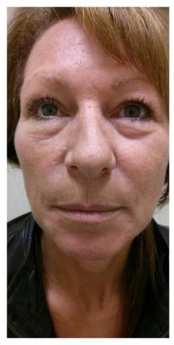 before- Oxygen-facial