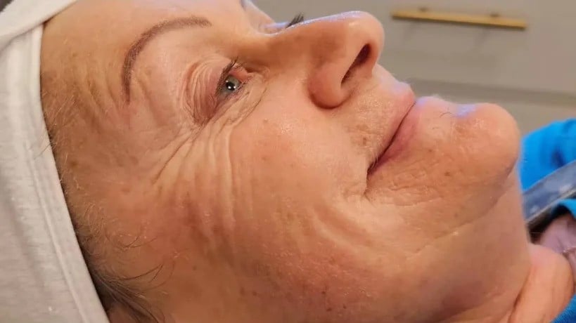 before-face-lift-treatment