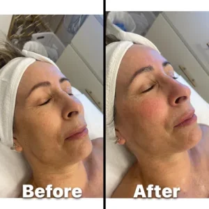 carbon laser peel- You Glow Aesthetics