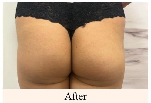 After a non-surgical butt lift at You Glow Aesthetics Calgary SE