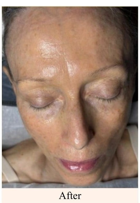 After- Face Tightening Treatment