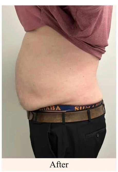 After-Laser-Lipo-Lower-Stomach