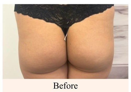 Before a non-surgical butt lift at You Glow Aesthetics Calgary SE