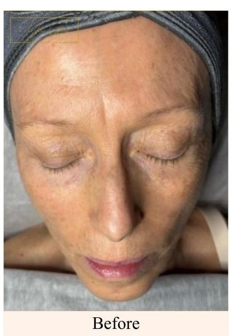 Before- Face Tightening Treatment