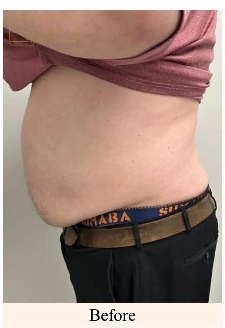 Before -Laser-Lipo-Lower-Stomach