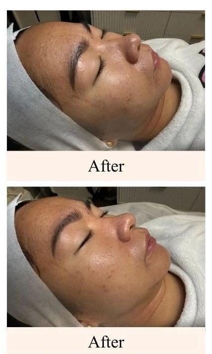 Chemical-Peel-after-image