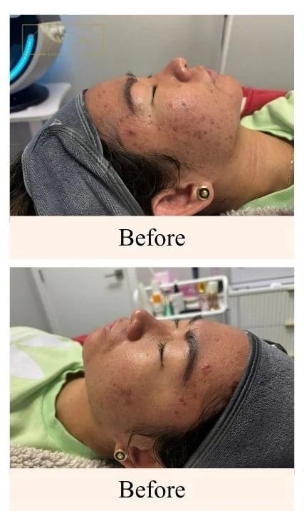 Chemical-Peel-before-image