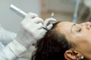 Scalp Microneedling Treatment for hair