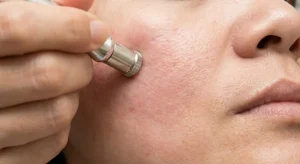Microdermabrasion Procedure
