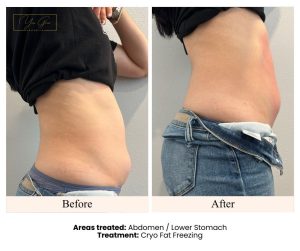 Before and After- Cryo Fat Freezing Lower Stomach Client 4