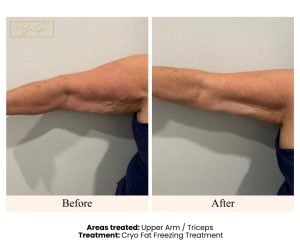 Before and After- Cryo Fat Freezing Upper Arm