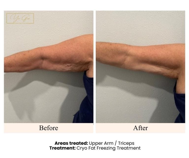 Stop Settling for Stubborn Fat: The Real Difference Between Cryo and Laser Lipo