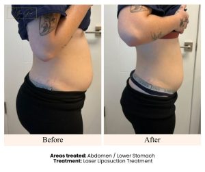 Before and After- Laser Lipo Lower Stomach