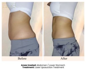Before and After- Laser Lipo Lower Stomach Client 11
