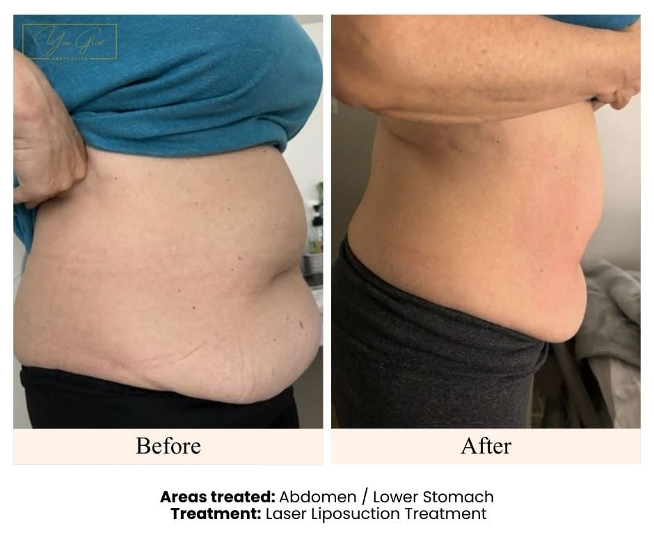 Before and After- Laser Lipo Lower Stomach Client 6
