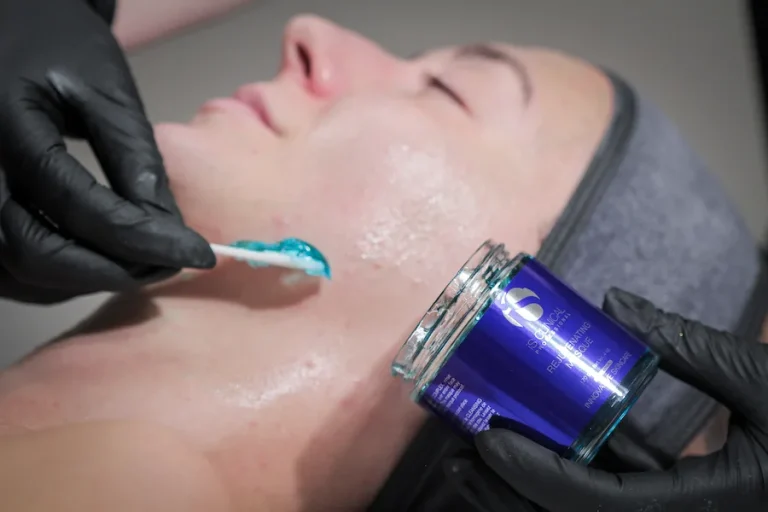 AFA Chemical Peel Treatments in Calgary NW