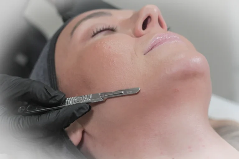 Dermaplaning Treatments in Calgary NW